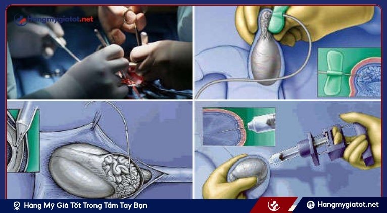 Các phương pháp lấy tinh trùng ở nam vô tinh