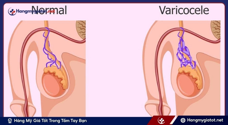 Sau mổ varicocele bao lâu nên đánh giá lại tinh trùng?